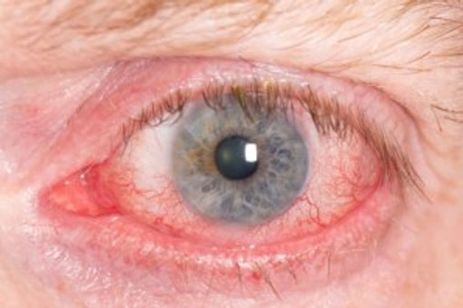 Preventing Poolside Pink Eye